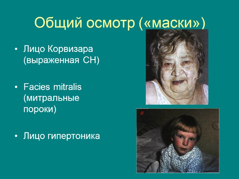 Общий осмотр («маски») Лицо Корвизара (выраженная СН)  Facies mitralis (митральные пороки)  Лицо